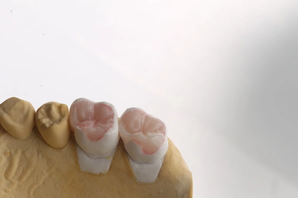 Modelo de dentes com restaurações em resina composta, representando o tratamento de cáries e fraturas leves em dentística restauradora.