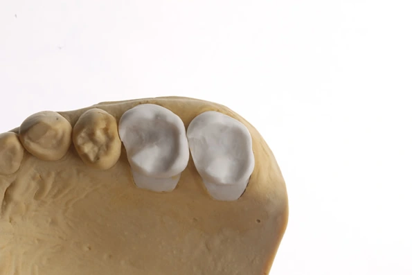 Modelo de dentes preparados para restaurações indiretas, que serão confeccionadas em laboratório para tratar áreas comprometidas.