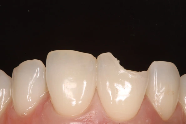 Dente frontal com fratura antes do tratamento estético, ideal para correção com faceta ou coroa.