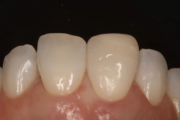 Dente frontal restaurado com faceta ou coroa, mostrando o resultado estético do tratamento.
