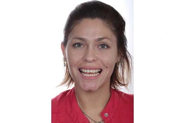 Paciente sorrindo antes de tratamento odontológico, ilustrando o estado inicial da dentição antes da intervenção estética.