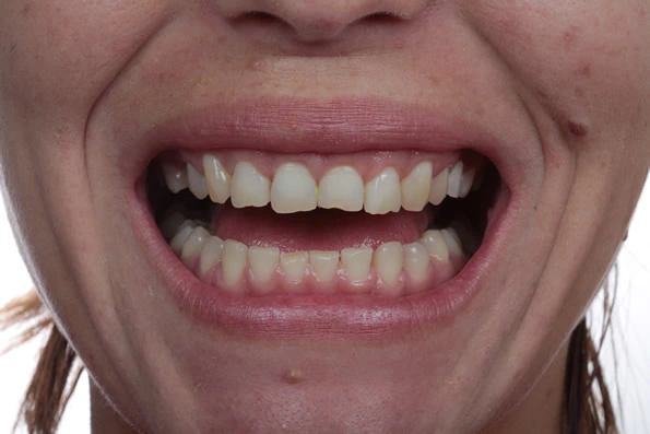 Paciente com espaçamento visível entre os dentes antes do início de tratamento corretivo e reabilitador.