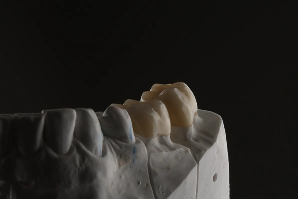Coroas dentárias posicionadas em modelo de gesso, simulando a aparência final após a instalação na arcada dentária.
