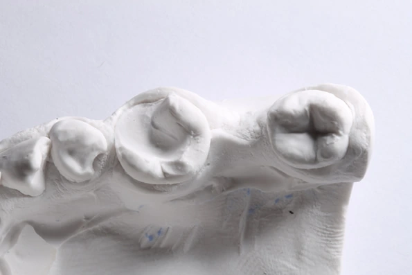 Modelo de dentes com restauração indireta, usando porcelana ou resina composta para maior durabilidade em fraturas extensas.