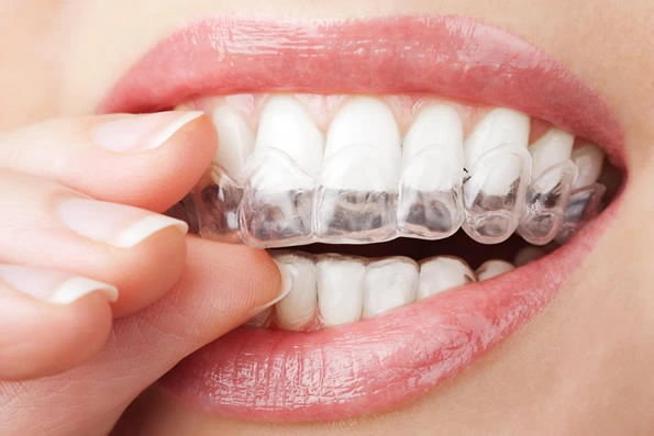 Paciente ajustando um alinhador dental transparente nos dentes, utilizado para correção discreta de alinhamento dentário.