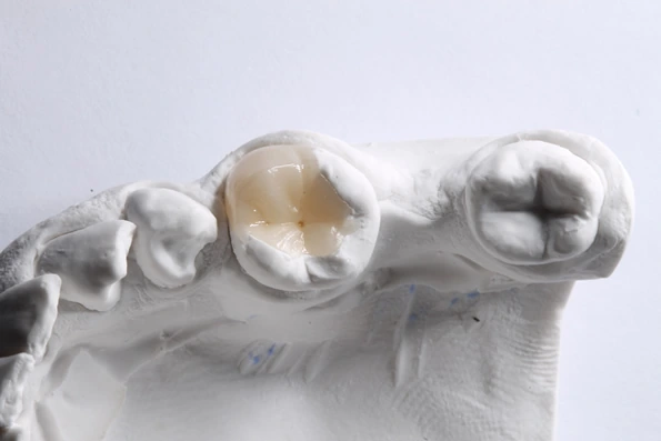 Modelo de dentes mostrando tipos de restauração inlay e onlay, utilizados em casos de desgaste dental.