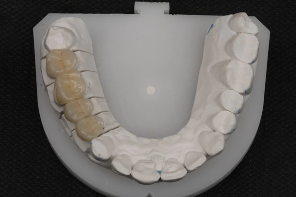 Modelo de arcada dentária inferior com várias restaurações, demonstrando um tratamento completo em dentística restauradora.