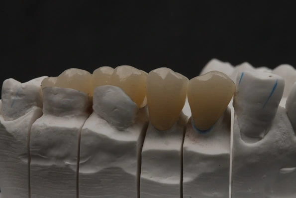 Vista lateral de modelo dentário com coroas e restaurações em porcelana, para casos de fraturas e desgastes mais extensos.