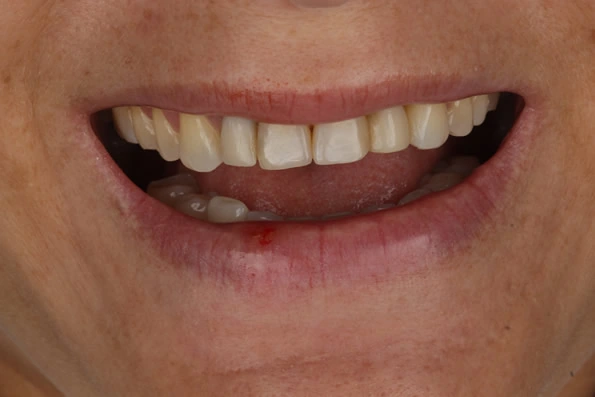 Sorriso com espaçamentos antes do tratamento estético com lentes de contato dental.