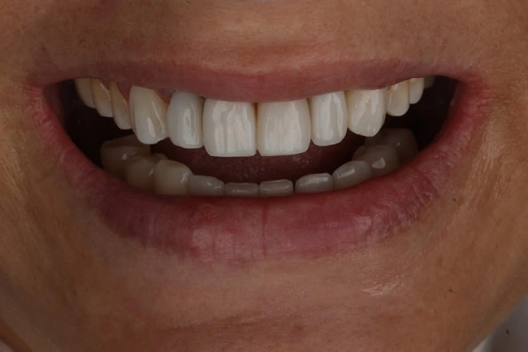 Sorriso completo restaurado com facetas ou coroas para correção de cor e alinhamento.