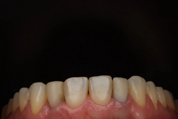 Dentes com desgaste e desalinhamento antes do tratamento de harmonização com facetas.