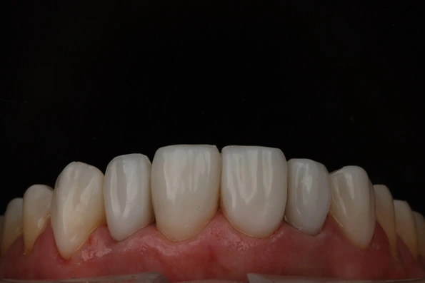 Dentes alinhados e esteticamente harmonizados após aplicação de facetas ou coroas.