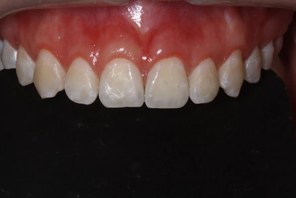 Imagem ilustrativa da saúde periodontal: gengiva saudável com cor rosa clara, contorno firme e levemente ondulado, sem sinais de inflamação ou sangramento, destacando a importância da prevenção e manutenção das estruturas de suporte dos dentes.