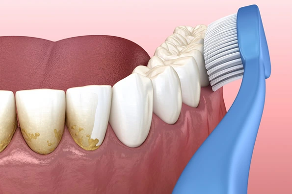 Pessoa escovando os dentes com escova de cerdas macias, destacando a importância da higiene oral diária para a prevenção de doenças gengivais.