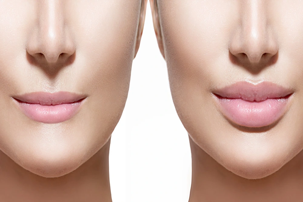 Aplicação de preenchimento labial com ácido hialurônico, realçando e restaurando o contorno e volume dos lábios para uma aparência natural e hidratada.