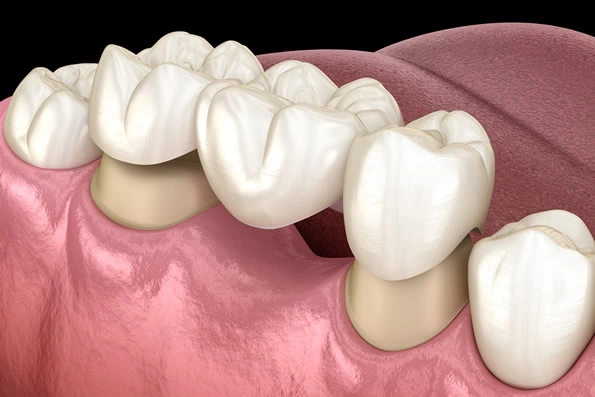 Prótese parcial fixa para reposição de um dente ausente, ancorada nos dentes adjacentes.
