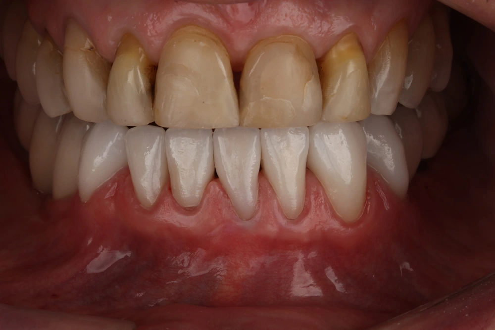 Exemplo de facetas de cerâmica para um sorriso mais bonito e harmonioso.