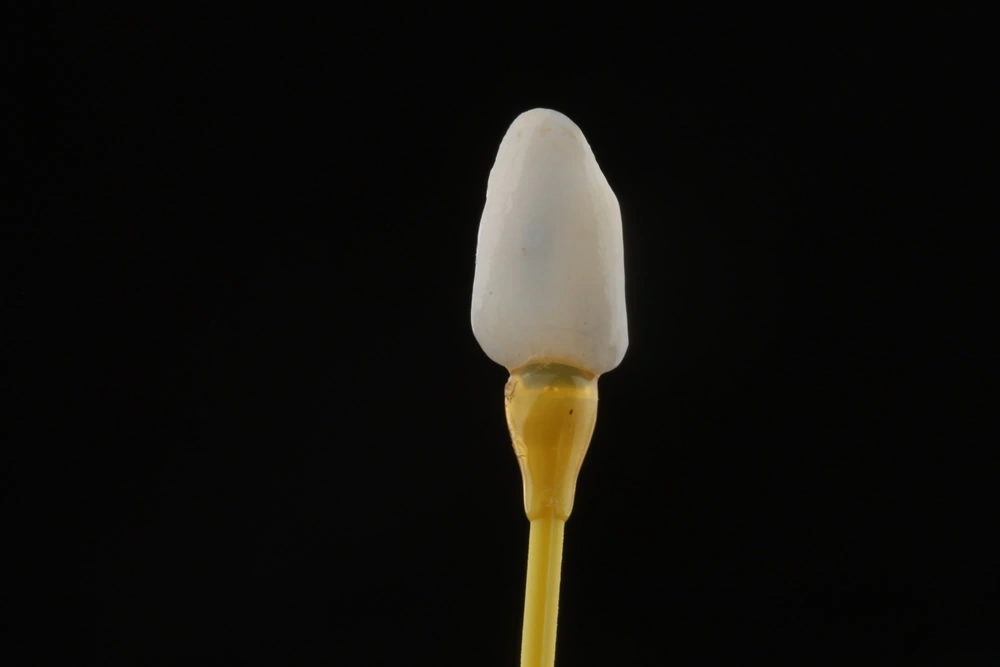 Dente com lente de contato em resina composta, oferecendo uma estética aprimorada.
