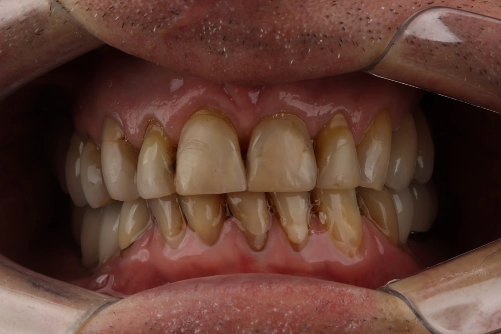 Facetas dentárias: solução estética para dentes naturais em busca de beleza.