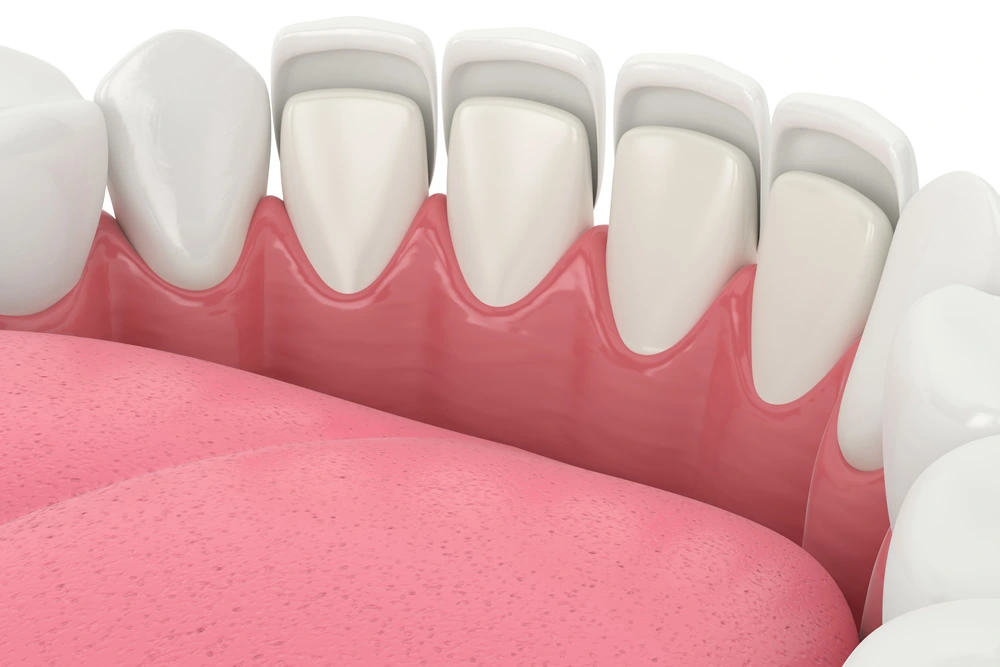 Restauração estética com facetas de cerâmica, melhorando a aparência dental.