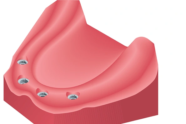 Prótese total fixa sobre implantes, substituindo todos os dentes perdidos com segurança e conforto.