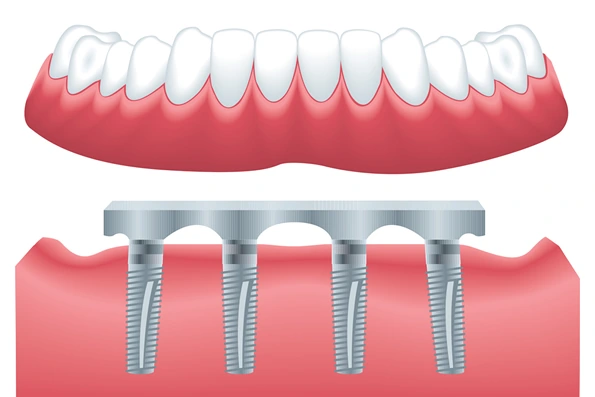 Prótese do tipo Protocolo para perda total dentária, fixa sobre implantes para maior estabilidade.