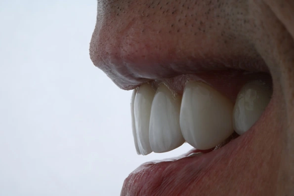 Prótese fixa sobre implantes para pacientes com perda de um ou mais dentes.