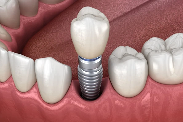 Prótese fixa sobre implante para reposição de um dente ausente sem comprometer os dentes adjacentes.