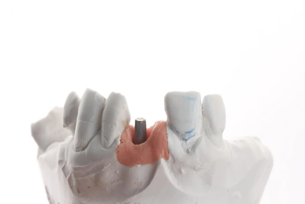 Prótese fixa sobre implante individual para substituir um dente perdido de forma segura e estável.