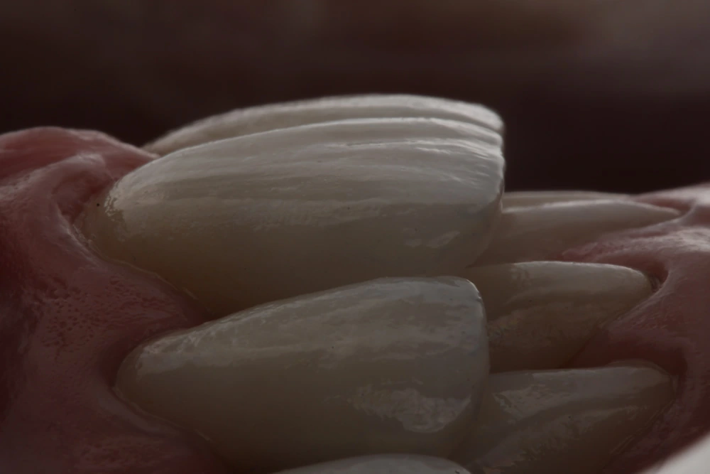 Facetas de cerâmica aplicadas sobre dentes naturais para melhorar a estética do sorriso.