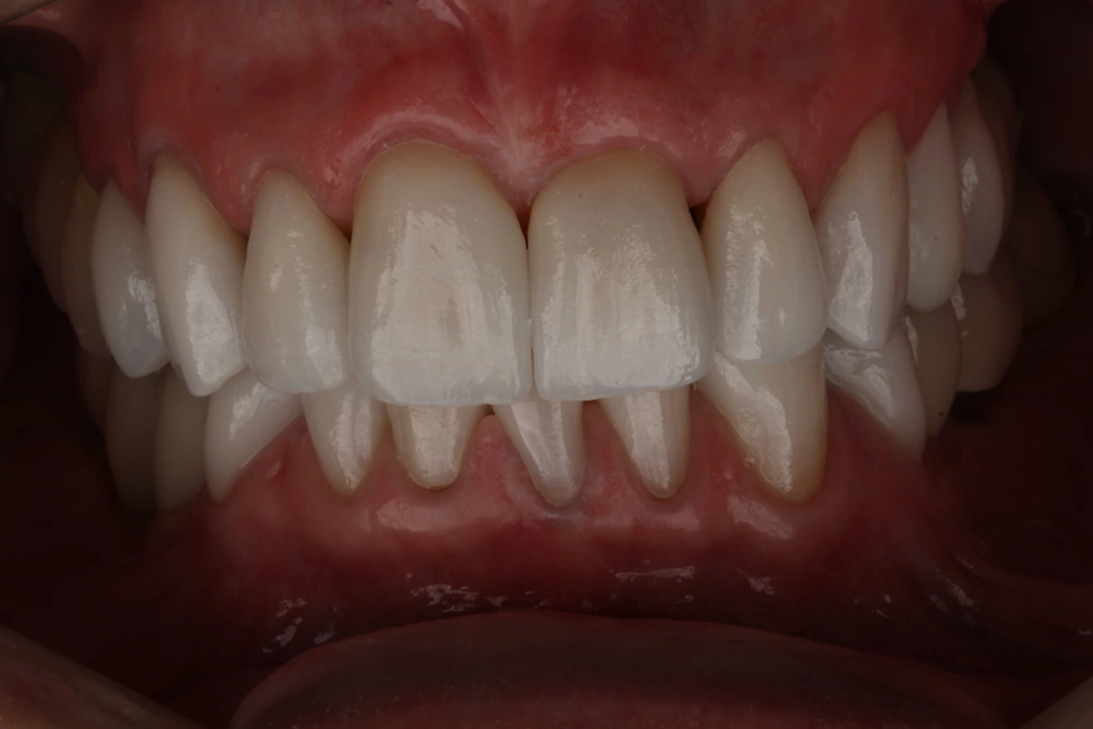 Lentes de contato dental em resina composta para restaurar a função e estética dos dentes.