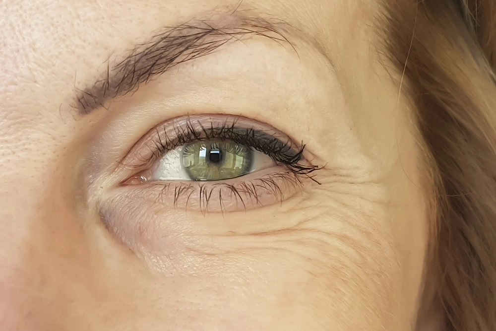 Procedimento com toxina botulínica para reduzir marcas de expressão causadas por movimentos faciais repetitivos, deixando a pele tonificada e sem rugas aparentes.