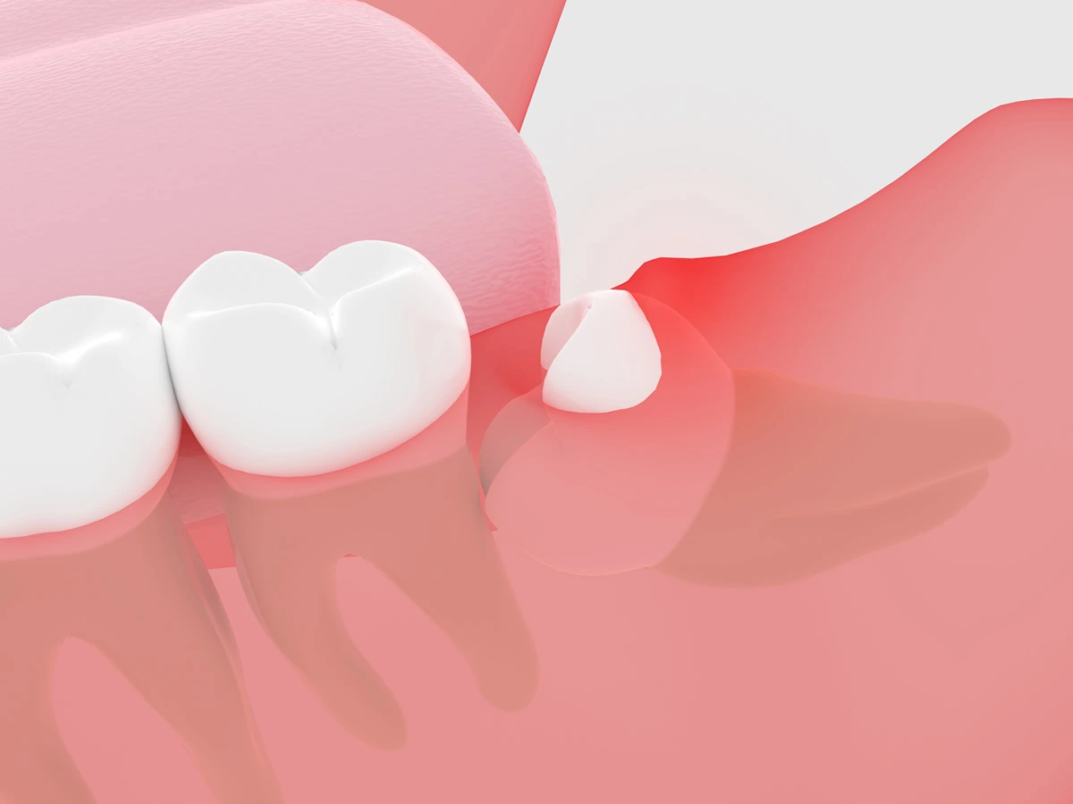 Imagem ilustrativa de remoção de um dente do siso, destacando a importância do procedimento para evitar inflamações gengivais e o risco de cáries em dentes adjacentes.