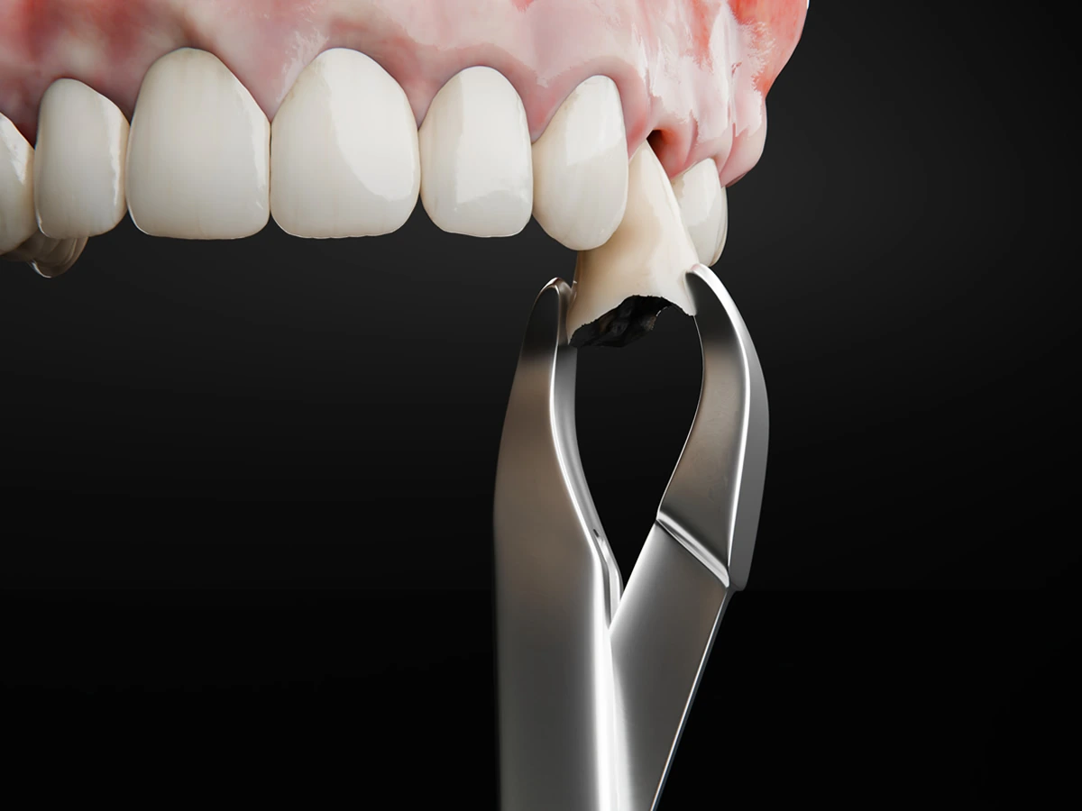Imagem de um dentista realizando a extração de um dente comprometido, destacando a remoção de dentes sem função mastigatória ou que causam inflamações e infecções bucais.