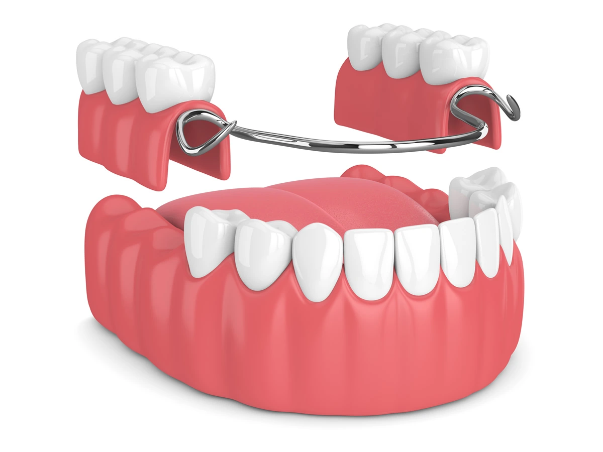 Cirurgia pré-protética, preparando a região bucal para a colocação de uma prótese, garantindo um encaixe adequado e confortável para o paciente.