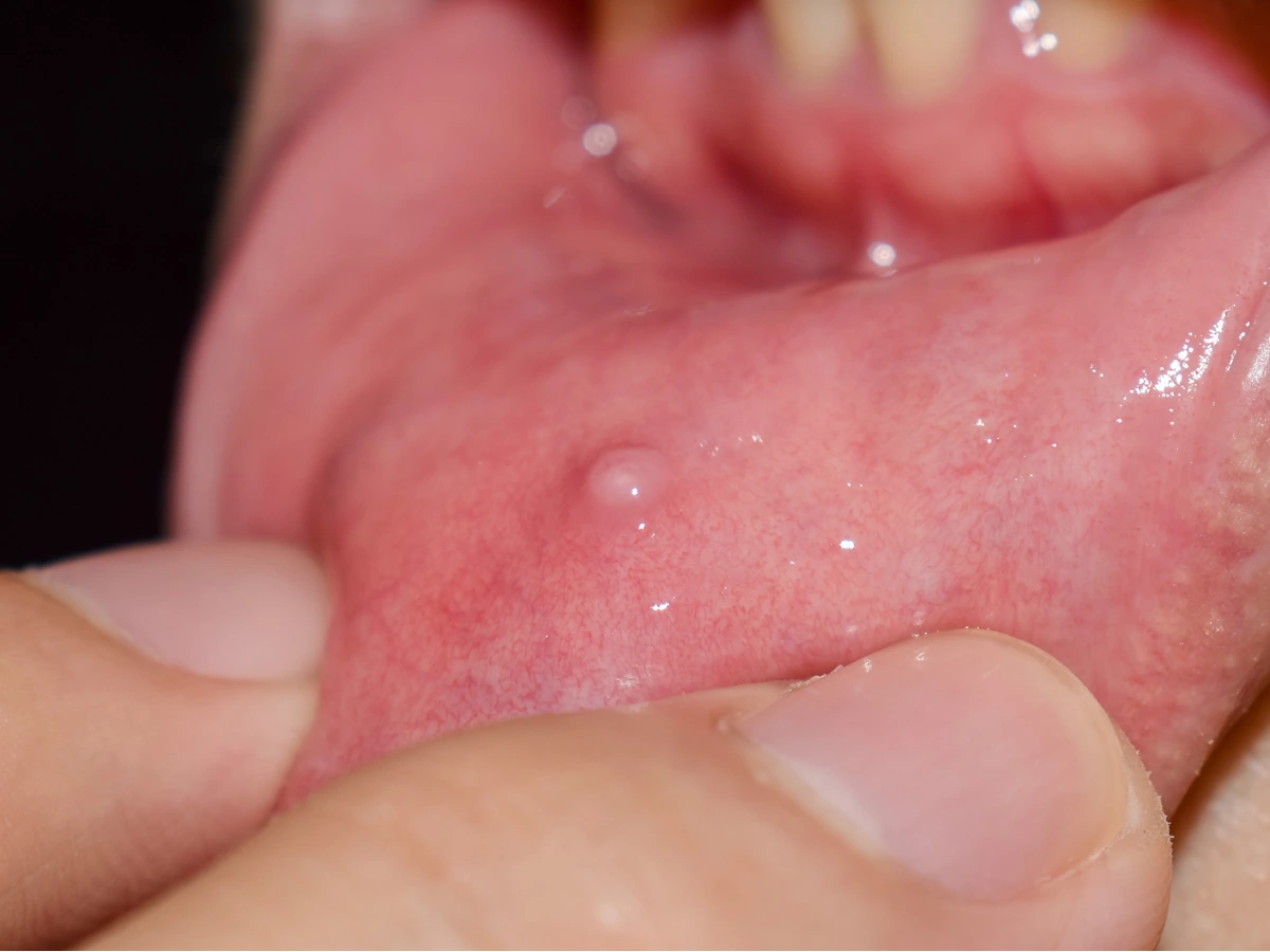 Imagem de um dentista realizando a retirada de um cisto menor na cavidade bucal, destacando a importância da cirurgia oral para remover proliferações de tecidos, infecções ou traumas, garantindo uma recuperação adequada do paciente.