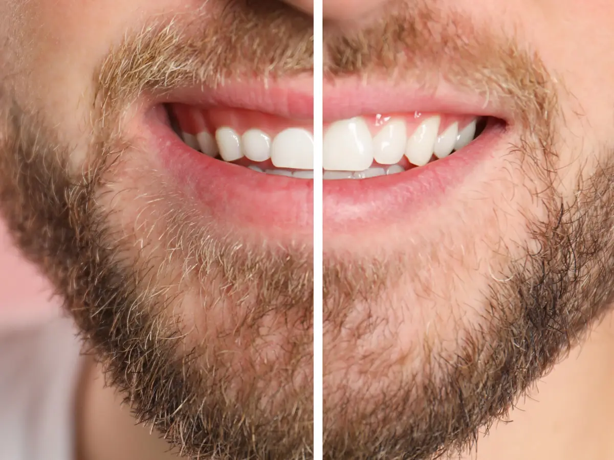 Cirurgia gengival para corrigir a estética do sorriso e remover tecido gengival, preparando a área para restaurações e próteses dentárias.