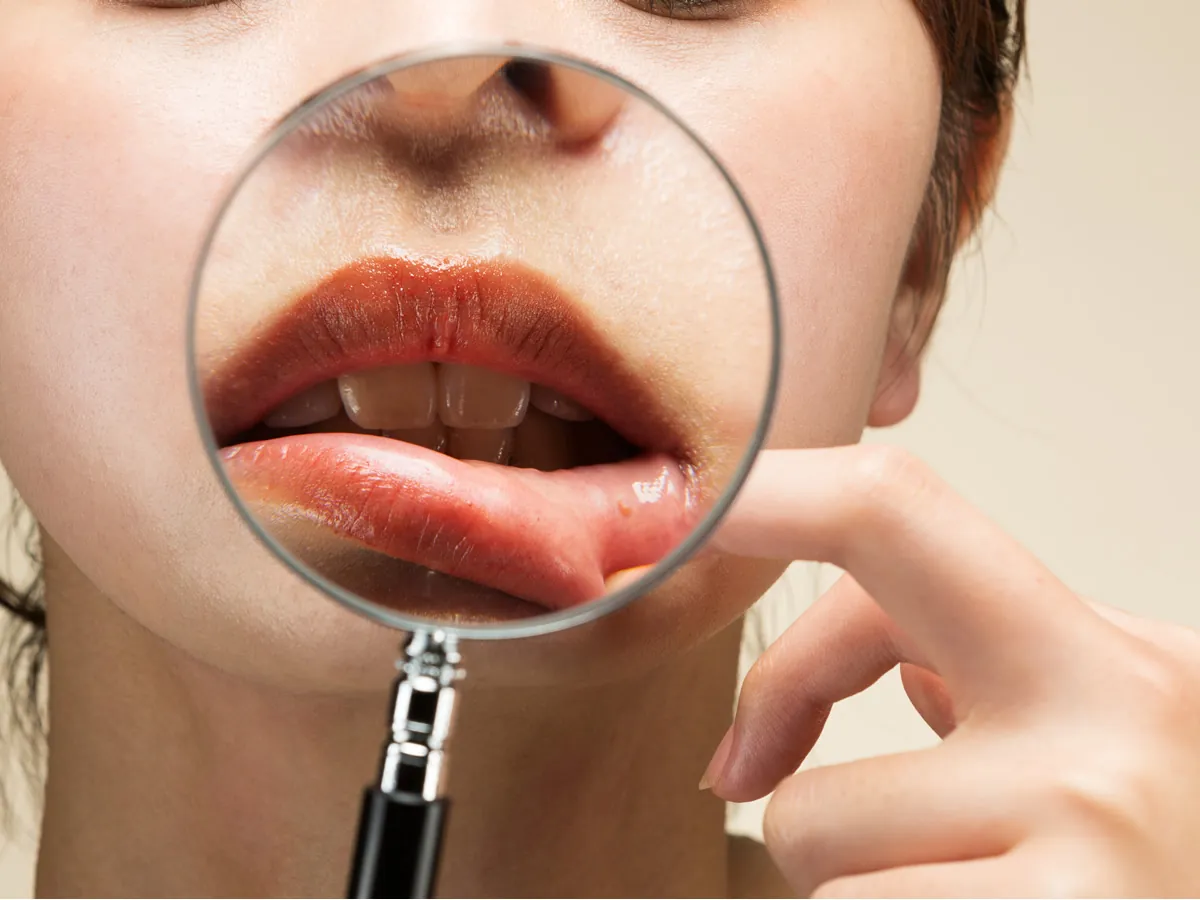 Retirando uma amostra de tecido para análise, com o objetivo de diagnosticar patologias, incluindo doenças como câncer bucal.