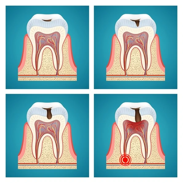 Imagem mostrando uma radiografia dentária destacando sinais de cárie profunda próxima à polpa, lesão periapical e inflamação.