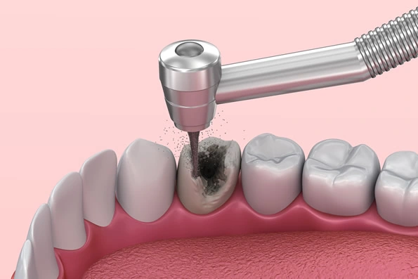 Imagem ilustrando o procedimento de tratamento de canal.