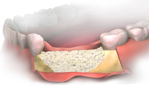 Ilustração de enxerto ósseo em área edêntula, mostrando a regeneração de tecido duro para pacientes com perda de volume ósseo, preparando para a futura instalação de implantes.