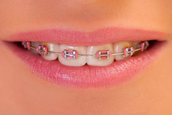 Sorriso com aparelho ortodôntico convencional com borrachinhas coloridas, destacando o uso tradicional desse tipo de aparelho para correção dental.