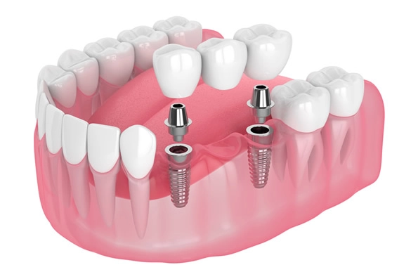 Ilustração de implantes dentários para perda parcial dos dentes, mostrando a fixação em áreas edêntulas sem afetar os dentes vizinhos.