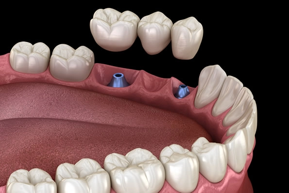 Ilustração de prótese dentária apoiada em implantes para substituição de dentes ausentes, preservando os dentes naturais adjacentes.