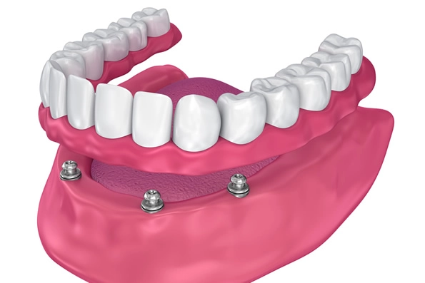 Ilustração de prótese dentária sobre implantes para pacientes com perda total dos dentes, mostrando os implantes na estrutura óssea para suporte da prótese com carga imediata.