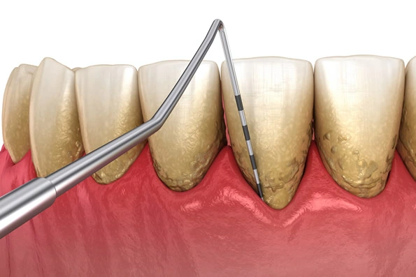 Destacando a avaliação da gengiva, sulcos periodontais, edema e recessão gengival durante um check-up odontológico.