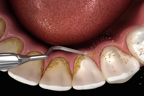 Imagem de raspagem periodontal, mostrando a remoção de placa e cálculo dental com instrumentos específicos.