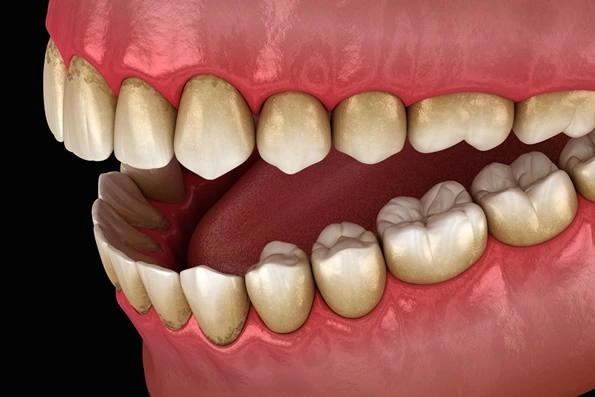 Imagem ilustrando os efeitos da placa bacteriana nas gengivas, mostrando sinais iniciais de gengivite, como vermelhidão, inchaço e sangramento, que podem evoluir para periodontite, com perda óssea, bolsas periodontais e recessão gengival.
